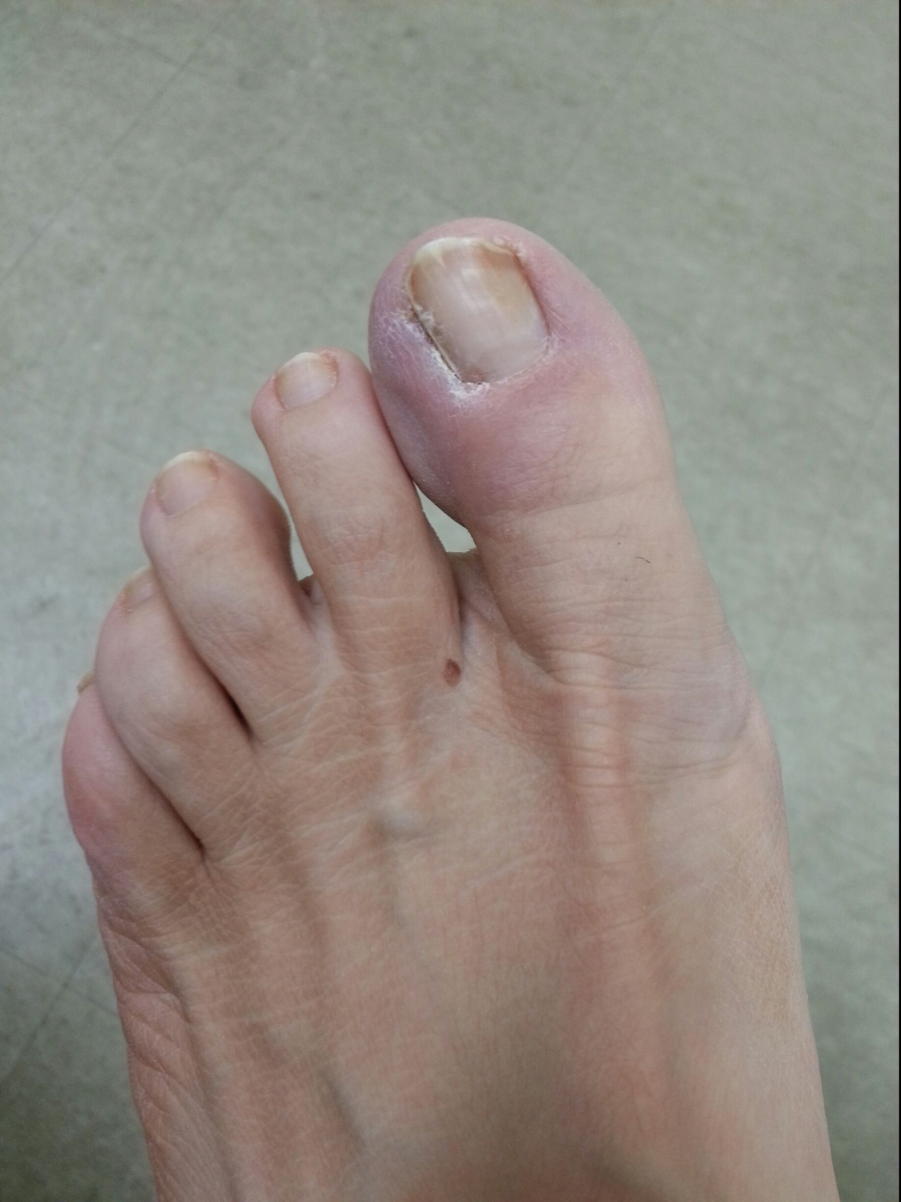 Picture of Fungal Nail Infection - WebMD